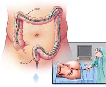 Ung thư đại tràng có thể phát hiện sớm bằng cách nào?